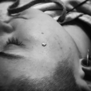 Microdermal